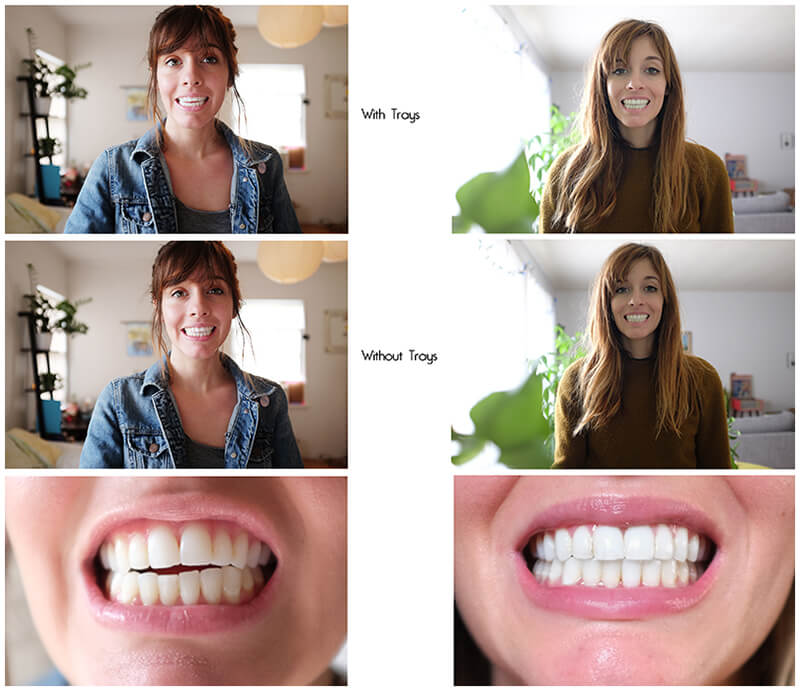 A collage of Jennifer before and after her Invisalign treatment 